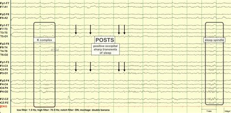 Posts Eeg Definition