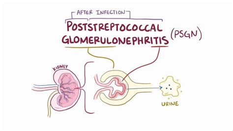 Poststreptococcal Glomerulonephritis Statpearls