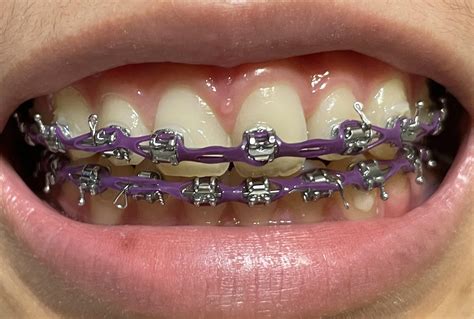 Power Chains Braces Reddit