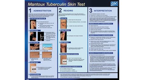 Understanding the PPD TB Skin Test: A Diagnostic Guide