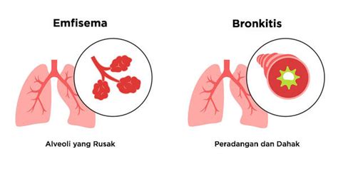 Signifikansi PPOK PDF