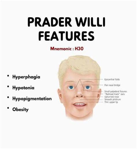 prader willi syndrome in infancy