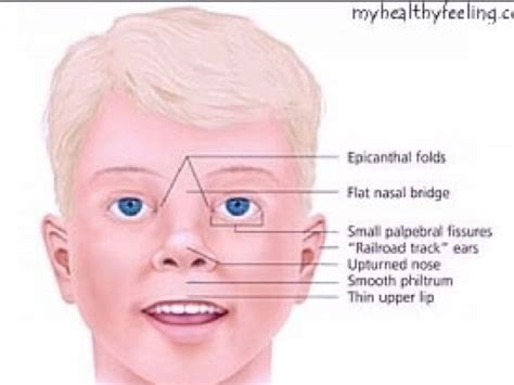 prader-willi syndrome pws