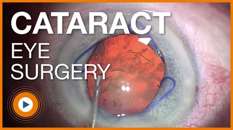 pre cataract surgery instructions