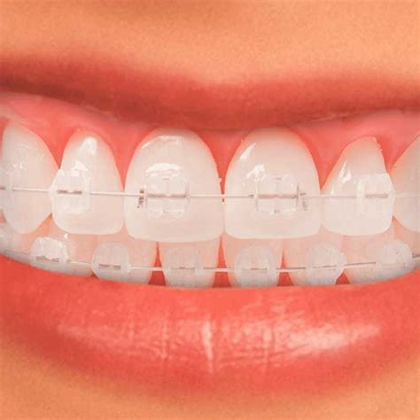 Precio Brackets Esteticos Transparentes