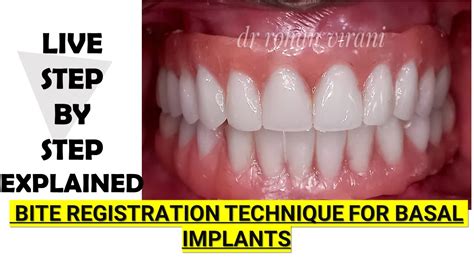 Precise Bite Registration Technique