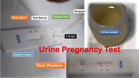How Accurate Is a Pregnancy Pee Test: Understanding Your Results