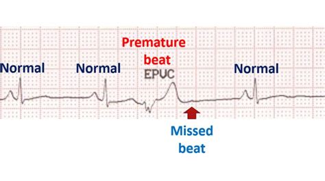 Understanding Premature Beats Causes: What You Need to Know About Heart Rhythm Disruptions