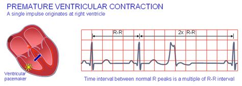 Understanding Premature Ventricular Contractions: Causes and Treatment Options