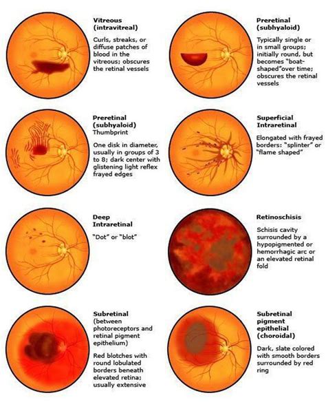preretinal hemorrhage vs vitreous hemorrhage