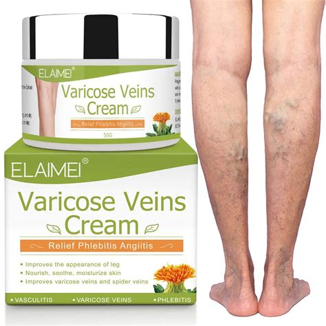 prescription cream for varicose veins