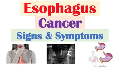 presenting symptoms of esophageal cancer