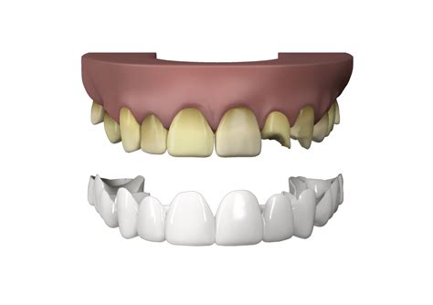 Press On Teeth Veneers