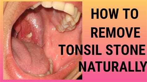 preventing tonsil stones naturally