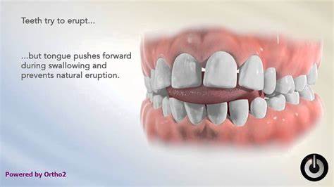 prevention of tongue thrust