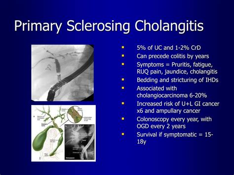 primary biliary cholangitis ibd