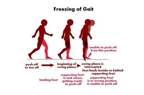 primary freezing of gait treatment