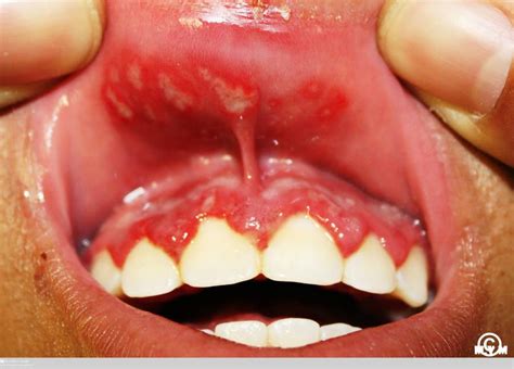 Understanding Primary Herpetic Gingivostomatitis: Causes, Symptoms, and Effective Treatment Options