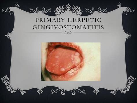 primary herpetic gingivostomatitis ppt