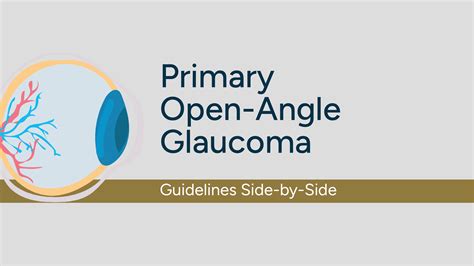 Primary Open Angle Glaucoma Gp Notebook