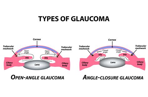 Primary Open Angle Glaucoma Pathophysiology