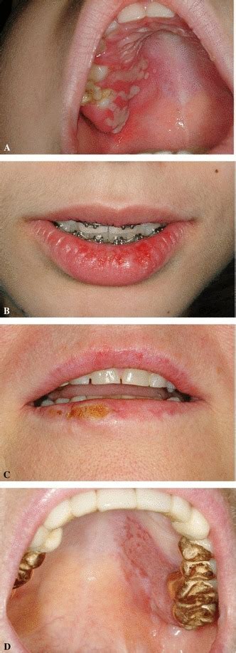 primary oral herpes simplex infection