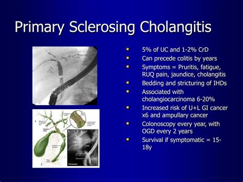 primary sclerosing cholangitis with ibd