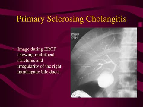 primary sclerosing cholangitis with ulcerative colitis