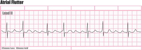 Printable Picture Of A Atrial Flutter