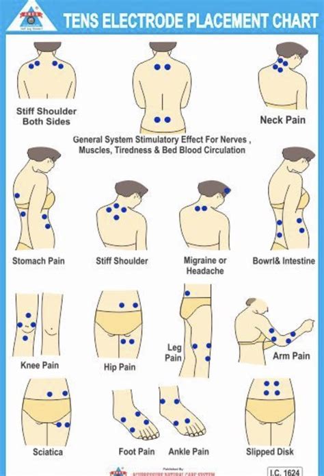 Printable Tens Electrode Placement Chart