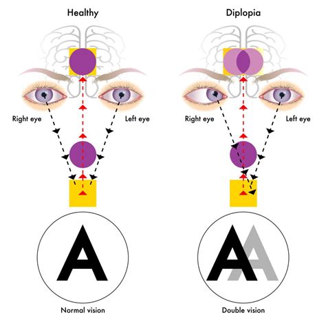 Prism Vs Double Vision
