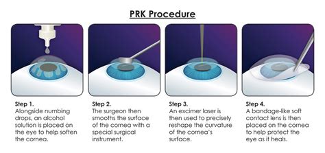 prk eye surgery procedure code