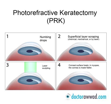 prk laser eye surgery information