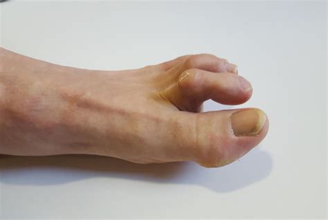 problemi alle dita dei piedi