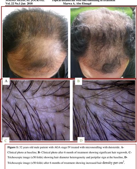 problems taking dutasteride 3 times a week