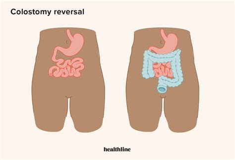Problems With Colostomy Reversal