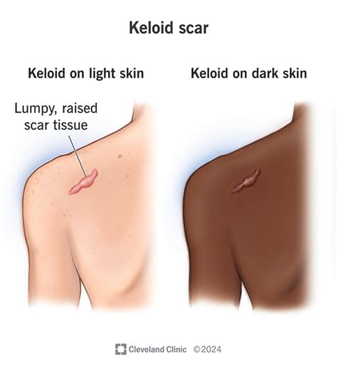 Problems With Keloid Scars