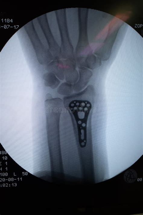 Problems With Titanium Plate In Wrist