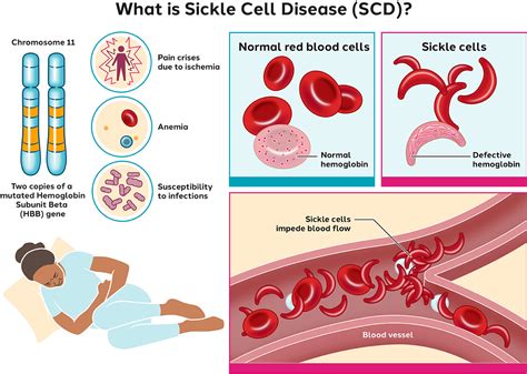 procedure codes for sickle cell disease
