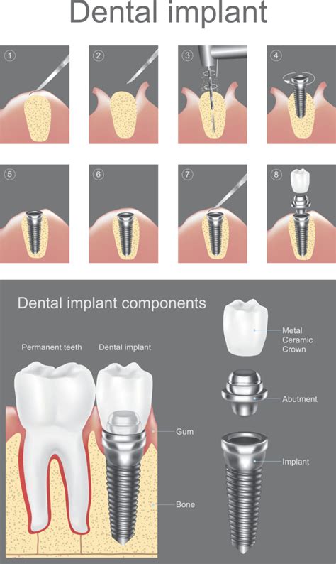 procedure dental implant process