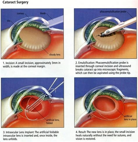 procedure for cataract surgery from beginning