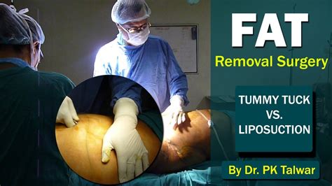 procedure to remove fat