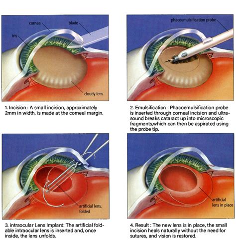procedure to replace fluid in the eye