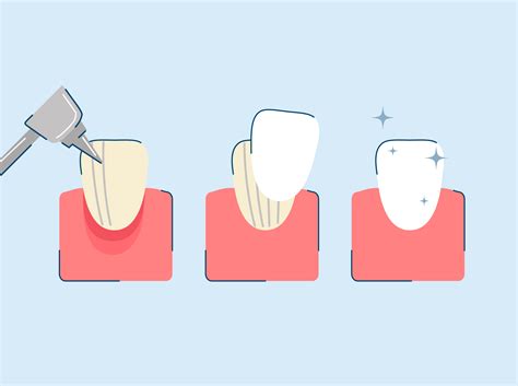 Process Of Veneers