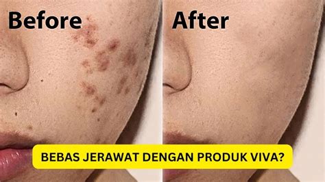 VIVA PAKET PERAWATAN KULIT BERJERAWAT Shopee Indonesia