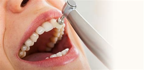professional-teeth-cleaning-services