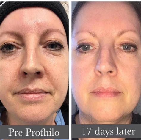 Profhilo Before and After Guide PRP London Clinic