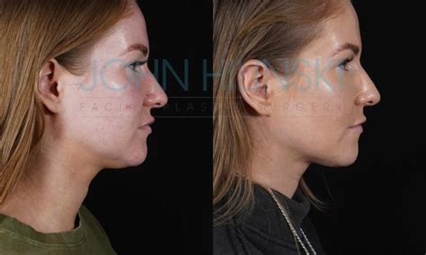 Facial Mole Removal San Diego CA