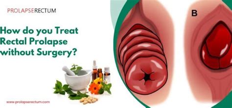 Effective Prolapsed Anus Treatment Options for Lasting Relief