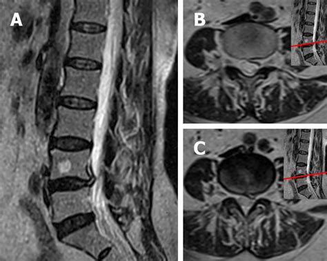 Prolozone For Herniated Disc